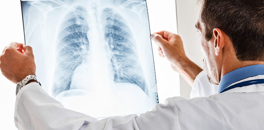 Akciğer kanserinin en büyük sorumlusu sigara - Dr. Sinan Akkurt Akciğer kanserinin en büyük sorumlusu sigara